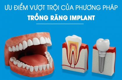 Ưu Điểm Vượt Trội Của Phương Pháp Trồng Răng Implant Trong Phục Hình Răng